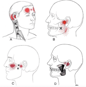 Your Frustrating Ear Pressure May Actually Be Your TMJ - The Jaw Therapist