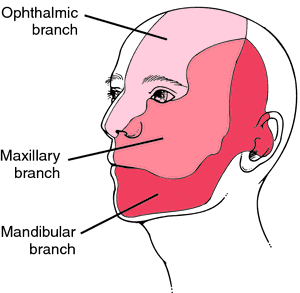 Trigeminal neuralgia Pain distribution