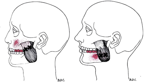 Masseter toothache referral