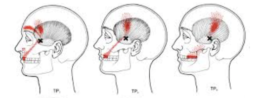 Temporalis toothache referral